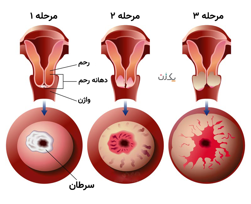 عکس سرطان دهانه رحم
